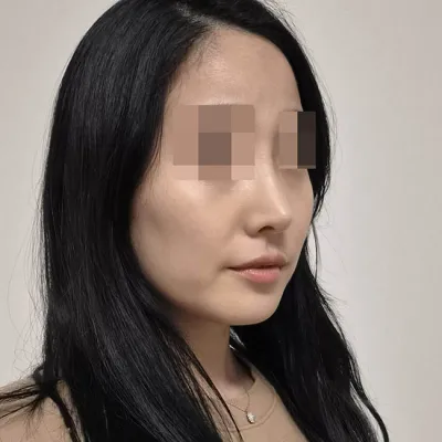 Mình đã phẫu thuật mũi lần đầu tại Want! (5 tháng sau phẫu thuật)