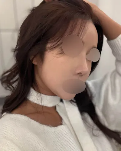 Mình đã phẫu thuật lại vì muốn cải thiện tình trạng mũi thấp và vẹo.