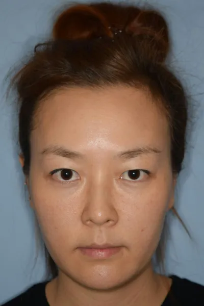 Đã 3 tháng kể từ khi phẫu thuật rồi nè. Mình đã tìm hiểu và đến tư vấn ở nhiều bệnh viện lắm... Nhưng mà không thấy có cảm tình với chỗ nào cả. Lúc đó mình vẫn còn phân vân không biết có nên phẫu thuật không nữa, vì sợ lỡ mà bị tác dụng phụ thì sao...