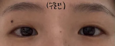 Review sau khi cắt mí + mở góc mắt