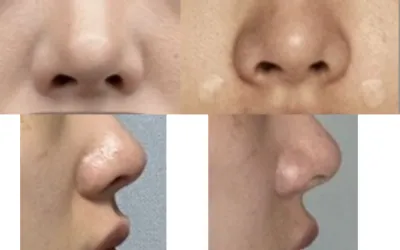 [Khách hàng **] Đánh giá sau khi tiêm filler rãnh cười