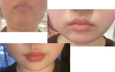 [Khách hàng **] Đánh giá sau khi điều trị InMode + tiêm Beauty Fit