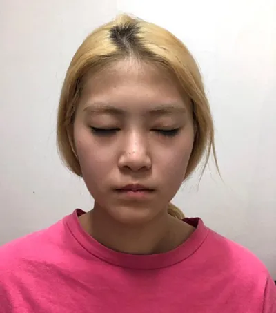 Review phẫu thuật mũi | mỡ | khác của mình