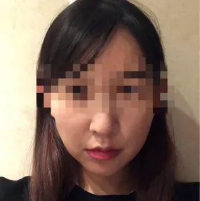 Review phẫu thuật căng da mặt của mình