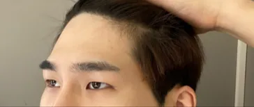 Mắt | Review phẫu thuật nâng cơ của mình