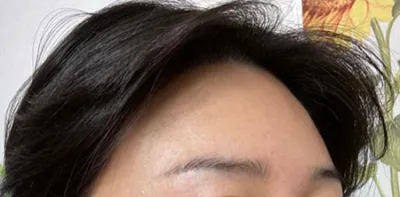 Review phẫu thuật mỡ của mình