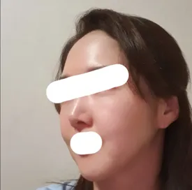 Tái phẫu thuật căng da mặt và hài lòng khi xem ảnh cũ ^^