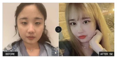 [Review Babitalk] Phẫu thuật mắt, phẫu thuật đường nét khuôn mặt sau một tháng / Biệt danh: Jiwaring