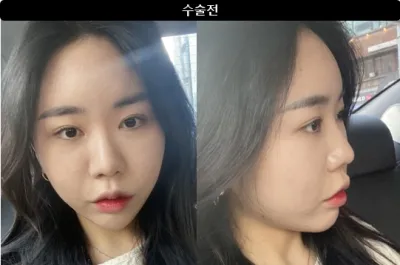 [Review Gangnam Unni] 1 tháng sau phẫu thuật nâng mũi / Biệt danh: Deureureureuk-deureureureuk