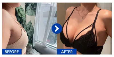 [Gangnam Unni] Nâng ngực (Motiva) / Tháng thứ 5 / Biệt danh: Regina0