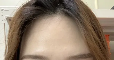 [Chống lão hóa] Là mình đây~~ - Cấy mỡ trán