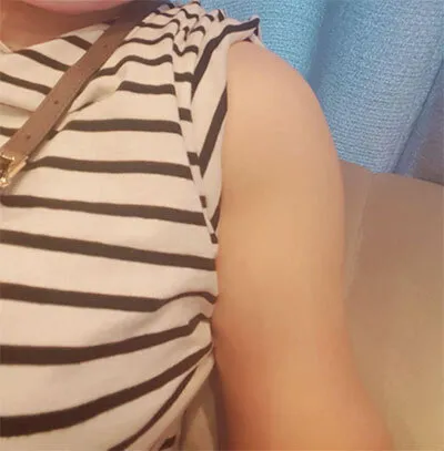 [Hút mỡ] Lariole - Hút mỡ