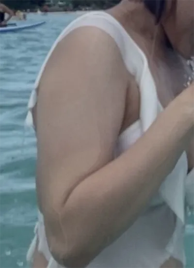 [Hút mỡ] Seo Ye- 팔 (Tay)