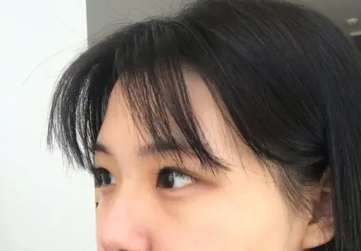 [Mắt] Ưng ắng - Cắt mí (liên kết tự nhiên), mở góc mắt trên