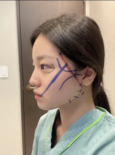 [Gọt mặt] Công chúa Gwangju công chúa - Gò má, cằm, xương hàm