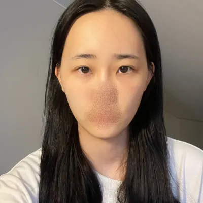 [Mắt] Sam Sam Oh Yu - Mắt, Cấy Mỡ, Đường Nét Khuôn Mặt