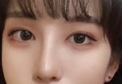 [Mắt] Bệnh viện Gangnam trắng - Mắt, mũi, gọt mặt 3 trong 1, nâng trán