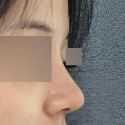 Đánh giá sau một tháng nâng mũi tại viện thẩm mỹ Weavers