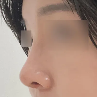 Mình đã phẫu thuật nâng mũi~! 