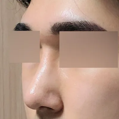 Đánh giá sau một tháng phẫu thuật mũi