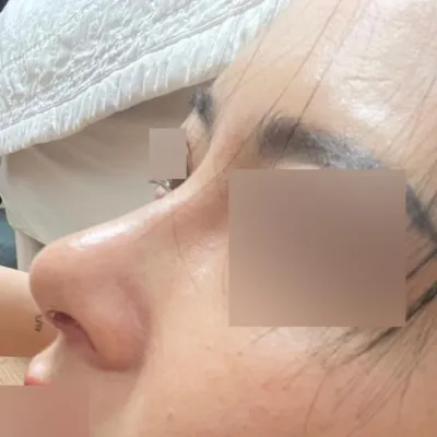 Mình đã phẫu thuật nâng mũi không dùng vật liệu độn ^^