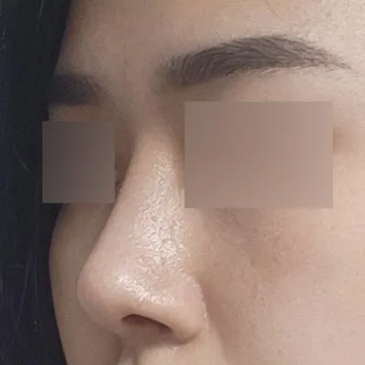 Đã 2 tháng kể từ khi phẫu thuật thu nhỏ đầu mũi!