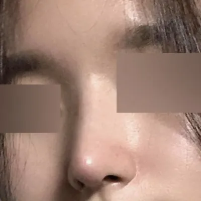 Đã 2 tháng kể từ khi mình phẫu thuật nâng mũi dáng thẳng