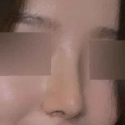 Cuối cùng cũng được 2 tháng kể từ khi phẫu thuật tại Weavers