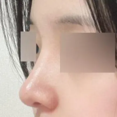 Đã 3 tháng kể từ khi mình phẫu thuật ở Wevers