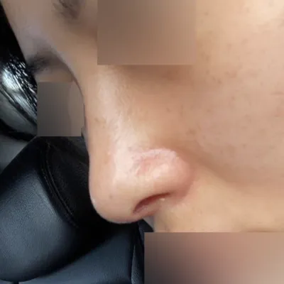 Mình đã phẫu thuật nâng mũi không độn