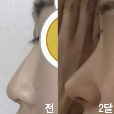 Mình đã phẫu thuật mũi diều hâu nam tính trở nên tinh tế hơn!