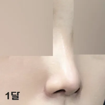 Sau một tháng, có vẻ như tình trạng sưng tấy giảm đi nhiều hơn nữa ~