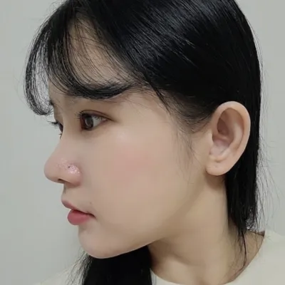 Đã được 1 tháng sau khi tái phẫu thuật mắt và mũi