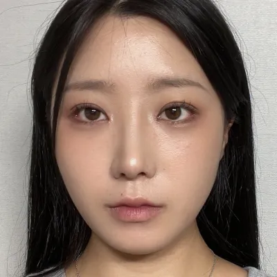 Đã được một tháng sau phẫu thuật ~