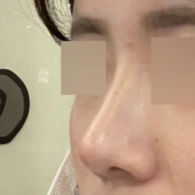 Đã được hai tháng kể từ khi mình phẫu thuật mũi!