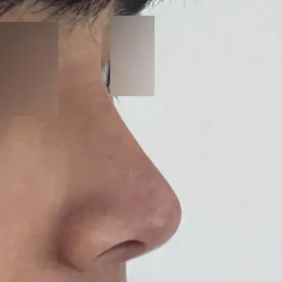 Đã 3 tháng kể từ khi mình phẫu thuật mũi tẹt.