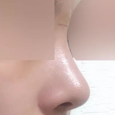 Đánh giá sau 3 tháng phẫu thuật mũi