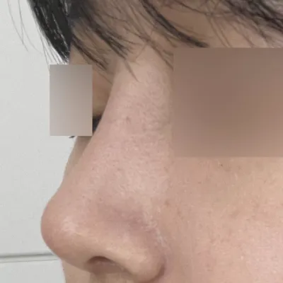 Đã thành công sau một tháng phẫu thuật mũi!