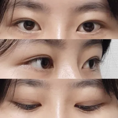 Mắt hết bầm trong 2 tuần và sạch sẽ không sẹo, không vết thương!