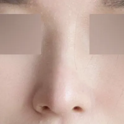 Đã 6 tháng kể từ khi phẫu thuật mũi