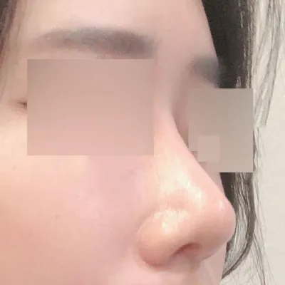 Bài đánh giá sau nửa năm kể từ khi mình có chiếc mũi mới!