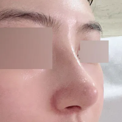 Cảm ơn bác sĩ Seo Seung-jo đã tạo cho mình chiếc mũi mơ ước!