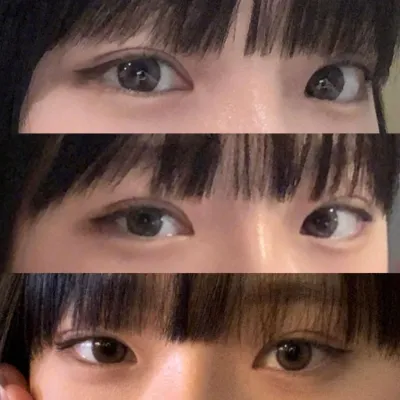 Mình đã phẫu thuật lại mắt và phẫu thuật mũi!