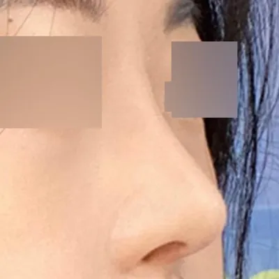 Mình rất hài lòng sau 2 tháng phẫu thuật.