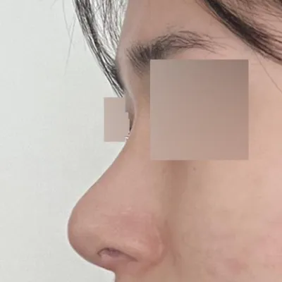 Mình đã phẫu thuật mũi tại Bệnh viện phẫu thuật thẩm mỹ Weavers được hai tháng rồi.