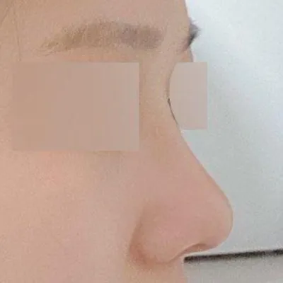 Sống mũi cao lên giúp khuôn mặt nhìn nghiêng cũng đẹp hơn và có chiều sâu hơn!