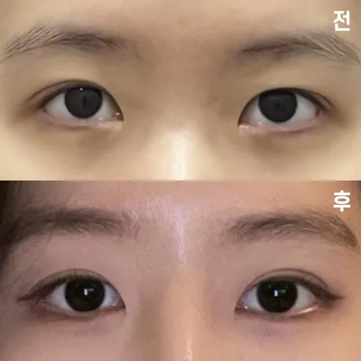 Mình đã phẫu thuật tại bệnh viện thẩm mỹ Wevers được 1 tháng rồi ~!