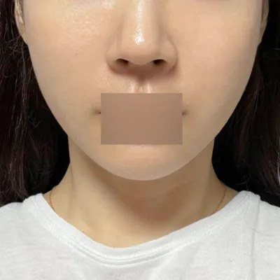 Đã 2 tuần kể từ khi nâng chỉ, hiệu quả thực sự rất rõ rệt!