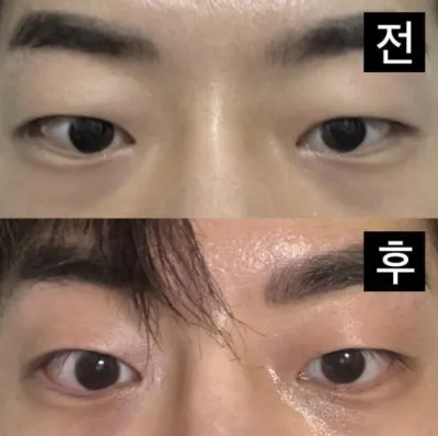 Không chỉ mắt mà mũi cũng thành công ngoài mong đợi