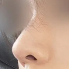 Mọi người nói rằng trông tự nhiên đến mức họ không biết mình đã phẫu thuật thẩm mỹ mũi.